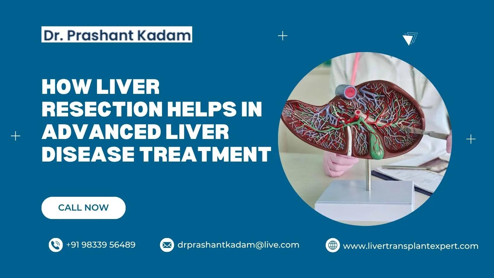How Liver Resection Helps in Advanced Liver Disease Treatment